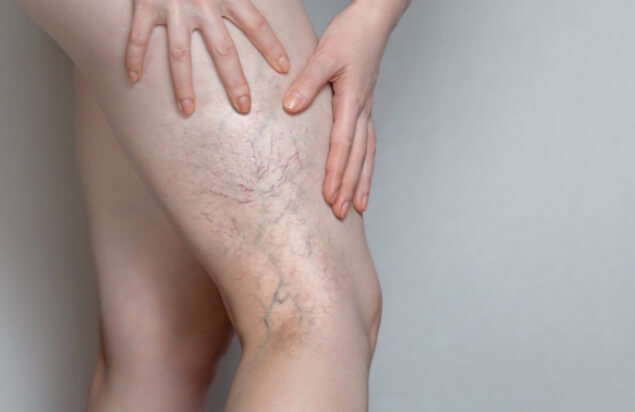 Legs veins